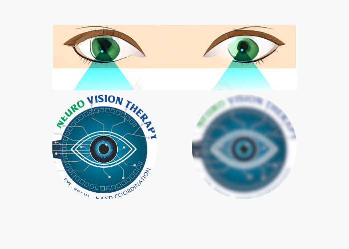 Amblyopia