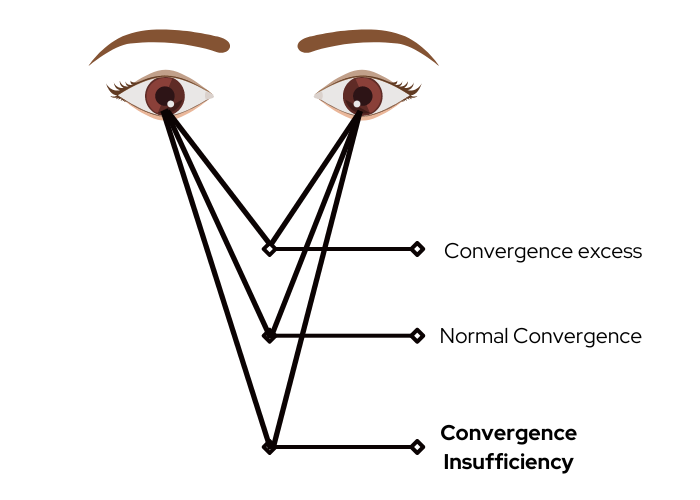 binocular vision disorders